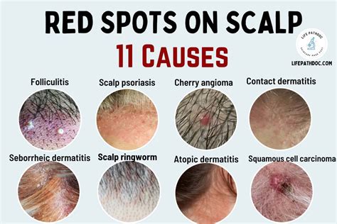 Red Spots on Scalp: 11 Causes, Pictures and Treatment 